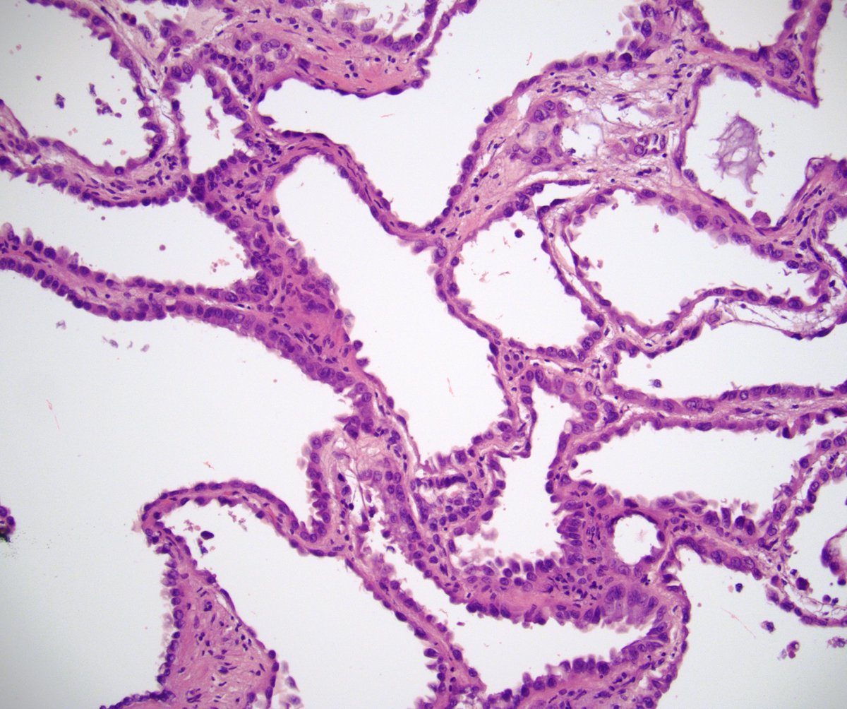 Pathoutlines's tweet photo. Case of the Month #484: A 34 year old man with a 1.4 cm mass underwent a partial nephrectomy.
See diagnosis, test question and discussion here: https://t.co/07xPfEZ7ur #pathology #pathologycase #renalpathology #pathologytestquestion #caseofthemonth https://t.co/NAUe28la0e