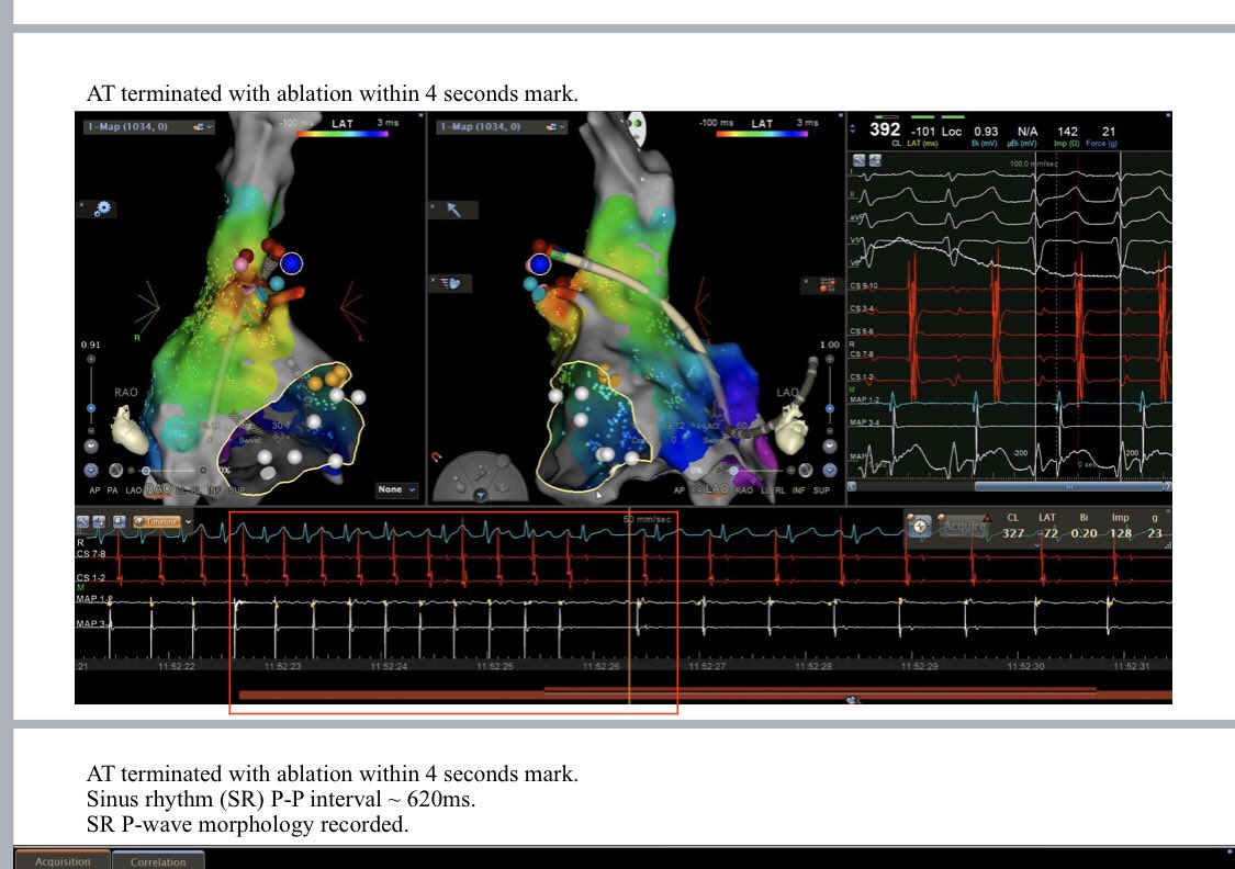 Dr. Surinder Khelae (@khelae_surinder) on Twitter photo AT from RAA terminates but recurs Used ICE too for precise location . any ideas Cryo freezor or surgery? @spafraz <a href="/ECGTalk/">Dr Koh Kok Wei</a> <a href="/DrRoderickTung/">Roderick Tung</a> AT from RAA terminates but recurs Used ICE too for precise location . any ideas Cryo freezor or surgery? @spafraz <a href="/ECGTalk/">Dr Koh Kok Wei</a> <a href="/DrRoderickTung/">Roderick Tung</a>
