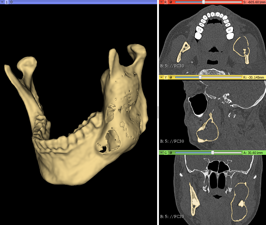 3d_maranon's tweet photo. The 3D model on the right shows a mandible with a cystic lesion. On the left, the mirrored version model of the healthy side. The latter will be use to bend a mandibular plate.

Work by the Marañón FabLab Team: @rupermac @calvoharo_ja @diegotrap @luciagds @LauraFloresBM https://t.co/M6XiUNn9Gp