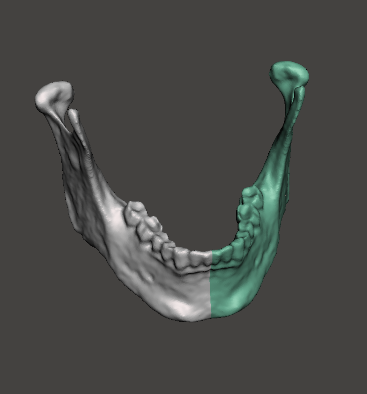 3d_maranon's tweet photo. The 3D model on the right shows a mandible with a cystic lesion. On the left, the mirrored version model of the healthy side. The latter will be use to bend a mandibular plate.

Work by the Marañón FabLab Team: @rupermac @calvoharo_ja @diegotrap @luciagds @LauraFloresBM https://t.co/M6XiUNn9Gp