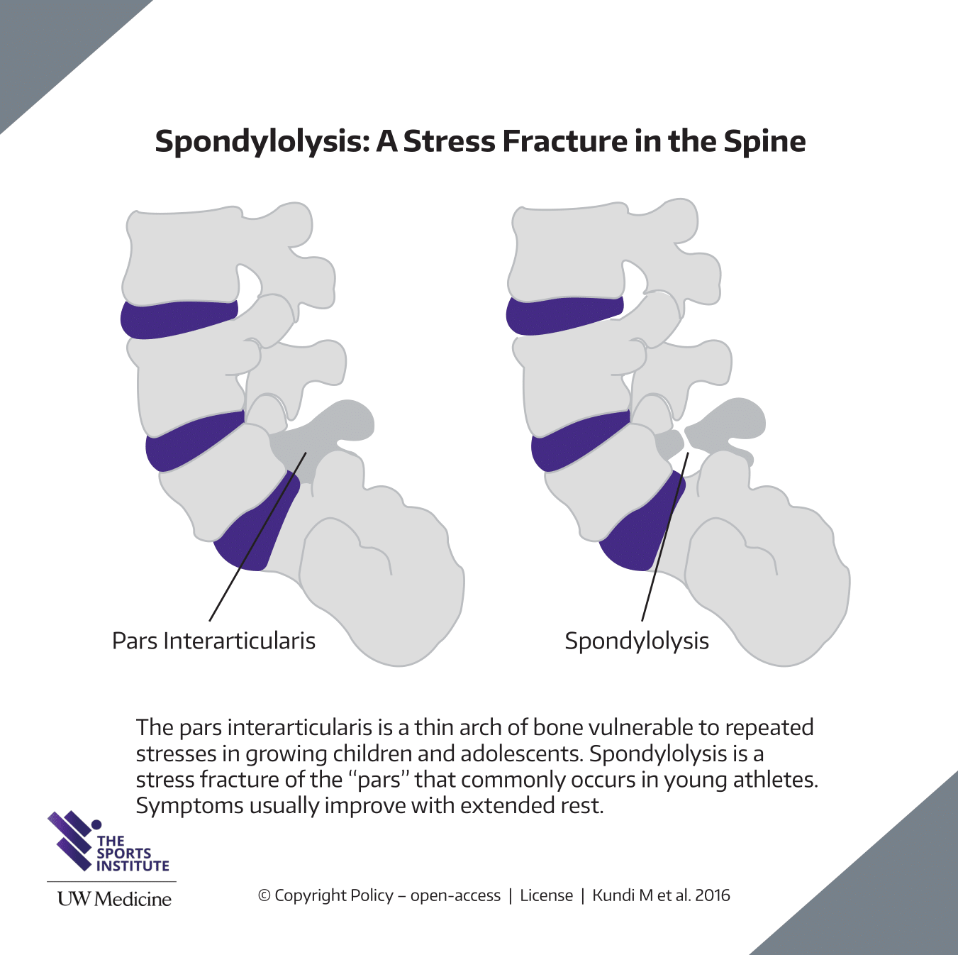 Low Back Pain In Adolescent Athletes Lumbar Spine Stress Fractures