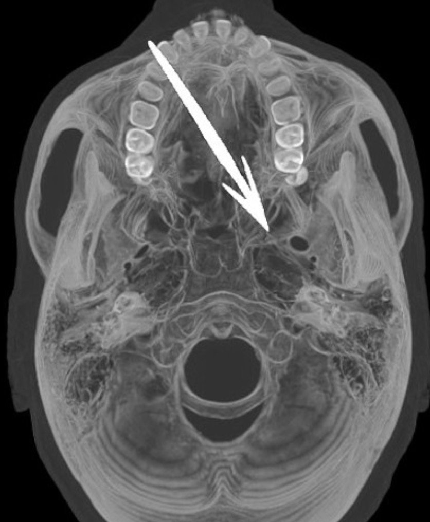 Looking for some advanced or unusual cases? Check out the collection highlighting the great work being done at Tenwek (Kenya) and Diospi (Peru) hospitals! 

Case collection: bit.ly/2Hr1L66

<a href="/Radiopaedia/">Radiopaedia.org</a> case link: bit.ly/2P84GVY

#FOAMrad #FOAMed #radiology