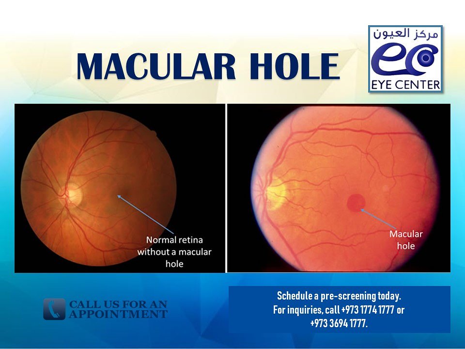 eyecenterbh's tweet photo. The macula is the central portion of the retina responsible for clear, detailed vision. As you age, the vitreous gel shrinks and pulls away from the macula; however, if the vitreous gel adheres to the macula and is unable to pull away, a hole will form. https://t.co/JGEFQZQy2R