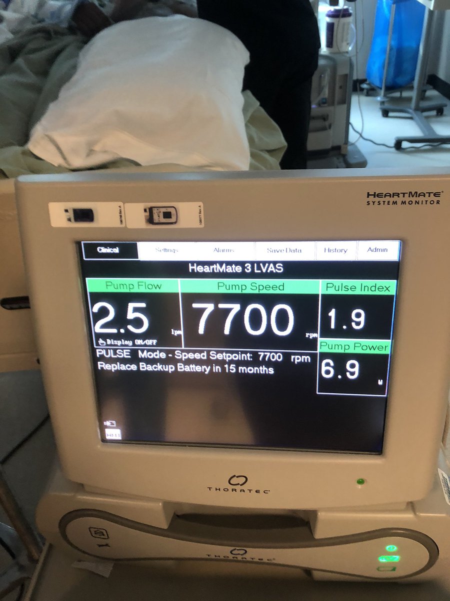 Andrew J Sauer MD (@andrewjsauer) on Twitter photo This is a HM3 not a HM2. This is abnormal. When trying to drop speed to 7500: continuous low flow alarms. What is the differential diagnosis? <a href="/IAmDrIbrahim/">ibraheem shah</a> <a href="/gmac78/">Gregory Macaluso</a> <a href="/yaleHFdoc/">Tariq Ahmad MD MPH</a> <a href="/MKIttlesonMD/">Michelle Kittleson MD PhD</a> <a href="/MichaelNassifMD/">Michael Nassif</a> <a href="/Abraham_Jacob/">Jacob Abraham, MD</a> <a href="/ajaysmd/">Ajay V. Srivastava MD</a> <a href="/hfdocbhimaraj/">Arvind Bhimaraj</a> This is a HM3 not a HM2. This is abnormal. When trying to drop speed to 7500: continuous low flow alarms. What is the differential diagnosis? <a href="/IAmDrIbrahim/">ibraheem shah</a> <a href="/gmac78/">Gregory Macaluso</a> <a href="/yaleHFdoc/">Tariq Ahmad MD MPH</a> <a href="/MKIttlesonMD/">Michelle Kittleson MD PhD</a> <a href="/MichaelNassifMD/">Michael Nassif</a> <a href="/Abraham_Jacob/">Jacob Abraham, MD</a> <a href="/ajaysmd/">Ajay V. Srivastava MD</a> <a href="/hfdocbhimaraj/">Arvind Bhimaraj</a>
