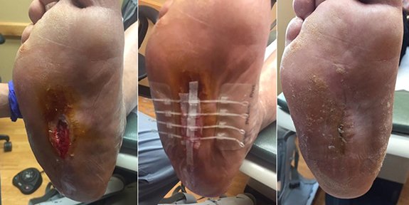 Closure of #wounds is one of the great challenges that #podiatrists face, particularly in the #diabetic and vascularly compromised patient. We recently started utilizing the ZipLine product in these difficult cases and the results have been remarkable.

prsnte.com/ignews95