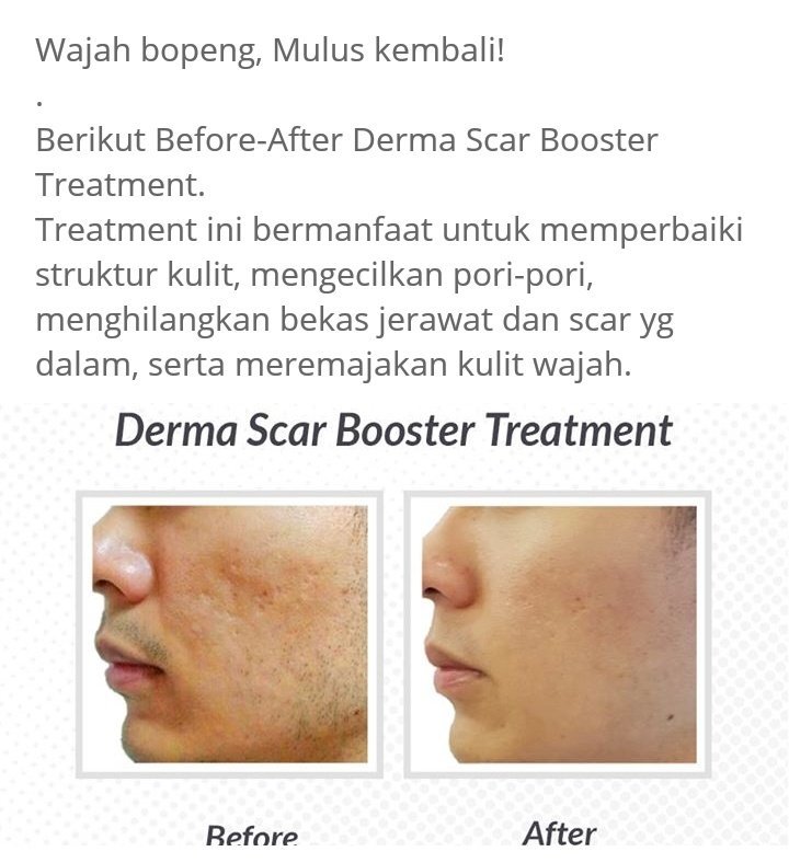 Impressions_'s tweet photo. Minder dengan bekas jerawat yang menimbulkan bopeng?
Ingin wajah mulus tanpa efek sampling? https://t.co/QEigkRy2JY