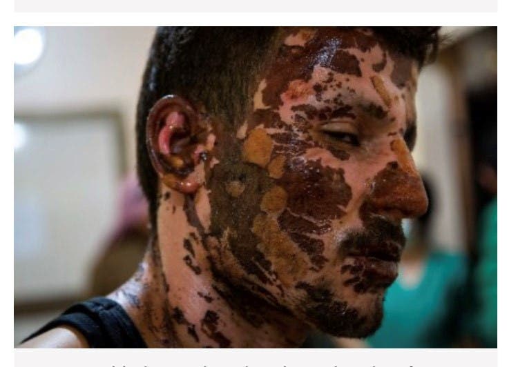 1ROJAVA's tweet photo. #Turkish #chemical #weapons
@realDonaldTrump
@EmmanuelMacron 
@ChrisVanHollen
@LindseyGrahamSC
@SecPompeo 
@UN 
@NATO 
@HeikoMaas 
@EU_Commission
#Kurds
#Rojava
#TwitterKurds 
#NoFlyZone4Rojava 
#KurdishGenocide
#BREAKING
#Syria https://t.co/g3xgQnzjZR