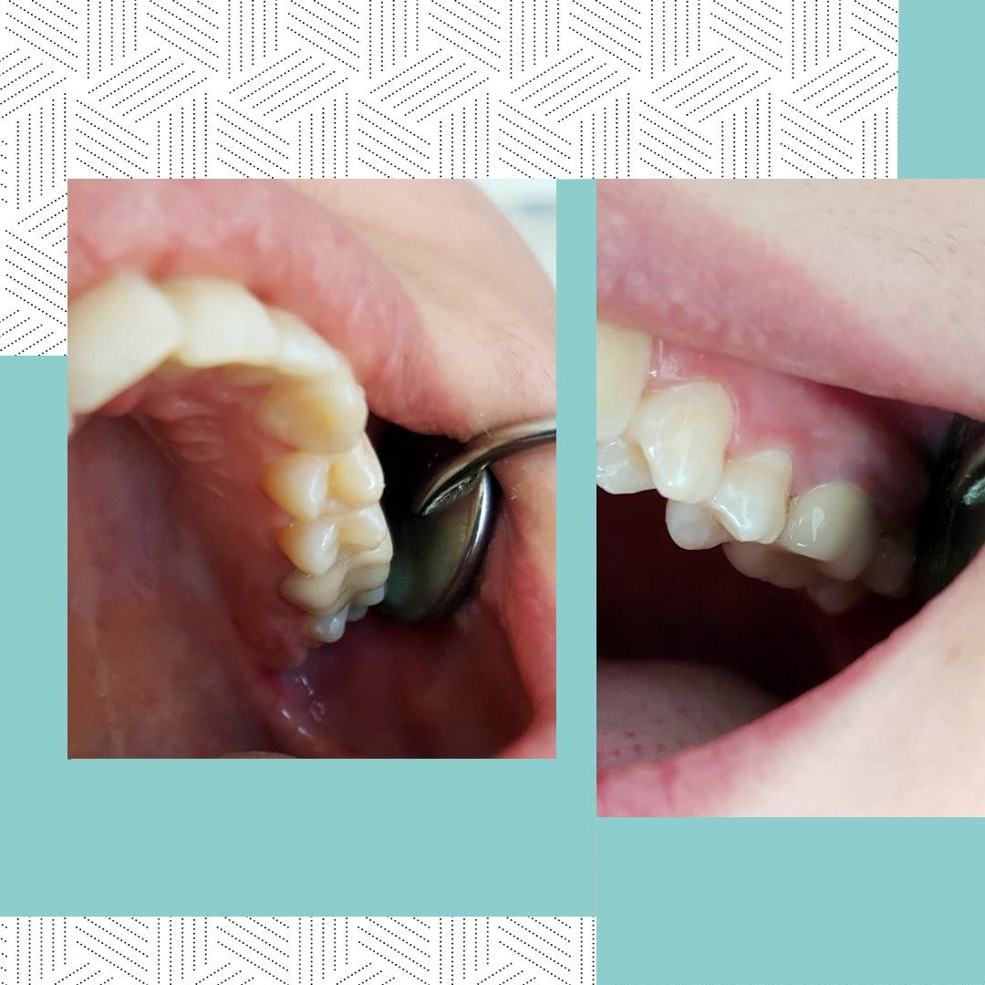 TheBestClinicML's tweet photo. Эстетическое и надежное восстановление разрушенного 26 зуба при помощи металлокерамической коронки. Фото пациента сразу же после фиксации. Работа доктора Марьям Мухамедовны. https://t.co/V3KWuAlK8F