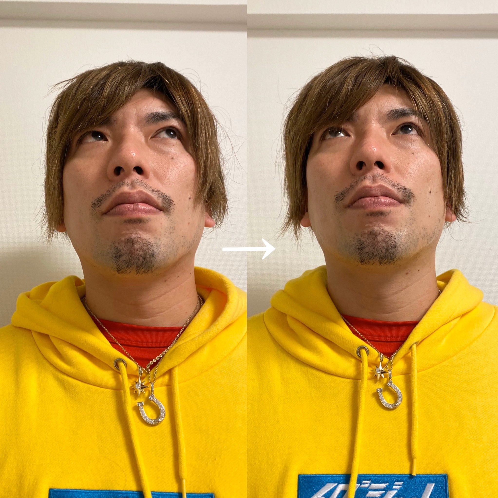 Twitter 上的 マジシャンフェイシャリストさおり 残りのビフォアアフターも Exitりんたろーさんありがとうございました 小顔マジック体験したい方はこちらから T Co G2jrtwfub6 T Co Gluzgytcq5 Twitter