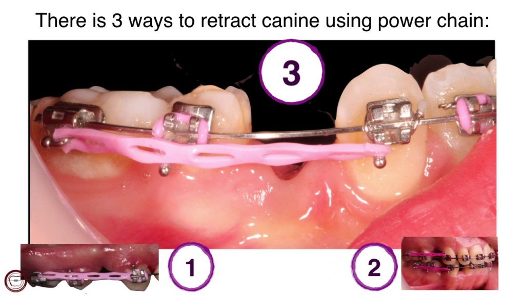 orthodontistsUK's tweet photo. canine traction by power chain in orthodontics by dr. Amr Asker https://t.co/7twq3uWKSg https://t.co/WcpzT2DdQM