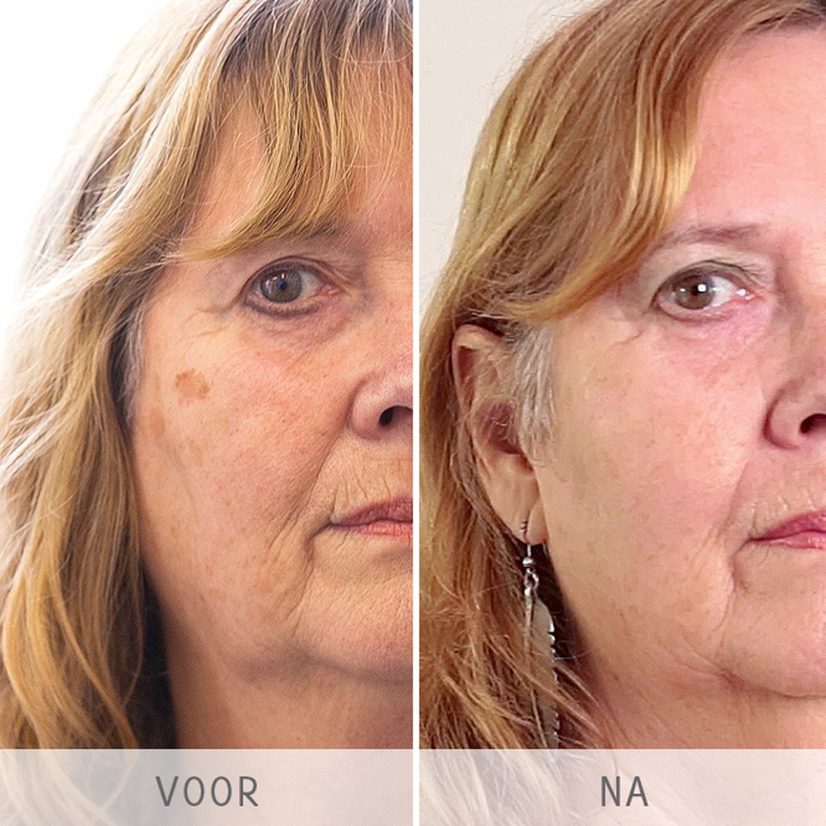 PolideBlaak's tweet photo. #pigmentvlekken veilig en snel verwijderen met de fractional CO2 laser. https://t.co/tDK2ipBxO8 #huidtherapie #cosmeticanatural #co2laser https://t.co/vN2qLFl7rI