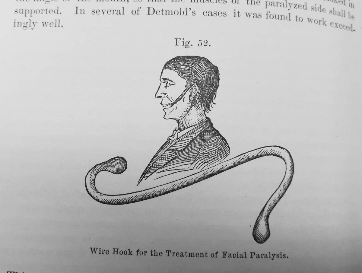 ManMedProject's tweet photo. The mechanical treatment of facial paralysis with "a piece of tin wire bent at both ends" is found to work "exceeding well" by Hamilton in his 'Nervous Diseases' (1878) #histmed #ManMedProject https://t.co/8RMvYd6tPo