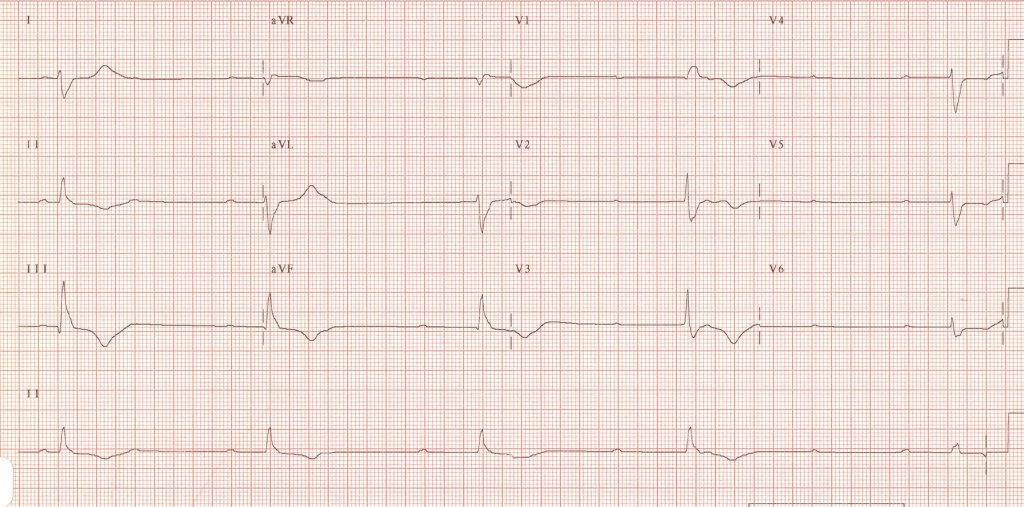 Welcome to the nightmares course! This week we introduce a new case series that originated <a href="/Qemerg/">QueensEM</a>. Check out Nightmares Case 1: Bradycardia. #FOAMsim <a href="/drcaners/">Kyla Caners</a> <a href="/chaplintim/">Tim Chaplin</a> emsimcases.com/2019/10/22/nig… emsimcases.com/2019/10/22/nig…