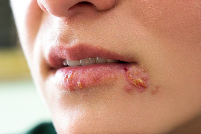 ed_walldmd's tweet photo. Why Hygienists Should NEVER Treat Patients with Active Fever Blisters/Cold Sores. Our goal is always the safety of the patient and the treating staff.   https://t.co/muCCxJTvDX https://t.co/8aWOY1Xy9l