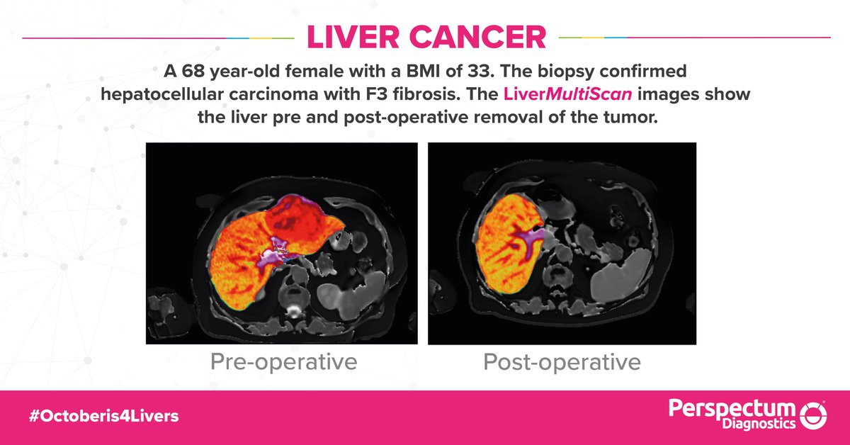 PerspectumGroup's tweet photo. An #MRI of the liver can be used to assist clinicians in the diagnosis of #liverdisorders. Here is a LiverMultiScan of a patient with #livercancer #Octoberis4livers https://t.co/JRsIu784Wo
