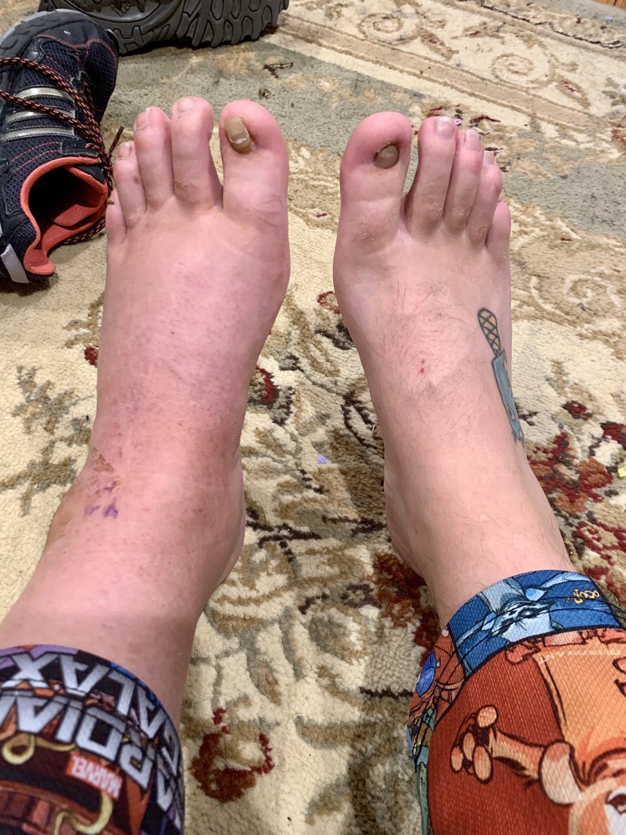 Jackalope_gg's tweet photo. 3 weeks out from surgery. I am just now able to start taking the bandages off and getting some air. Also physical therapy SUCKS. #anklestabilization https://t.co/jqRrDkH8ry