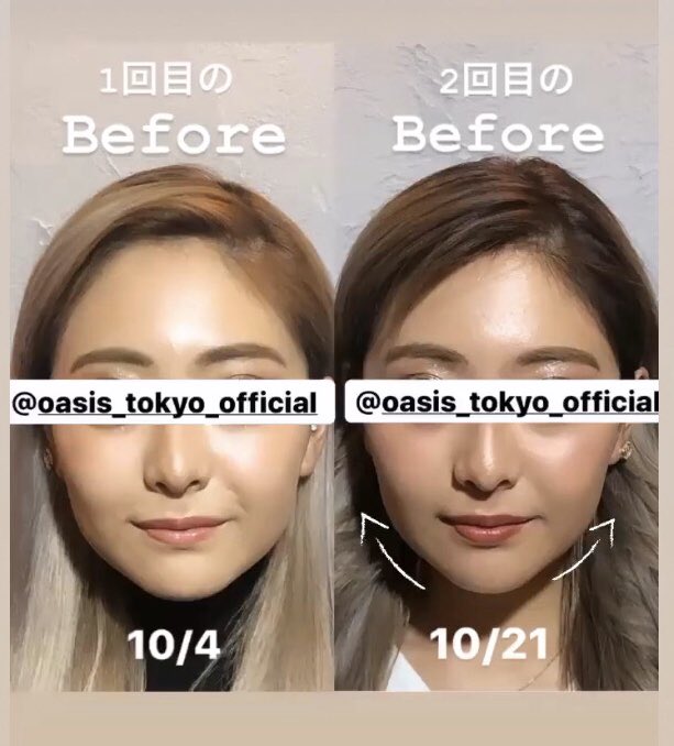 ミナミのオアシス こんにちは ミナミのオアシスです 美容鍼のビフォーアフターです 鍼の後 さらにフェイシャルマッサージもいたします 是非実感してみてください 美容鍼 サボテン美容鍼 ビフォーアフター 小顔