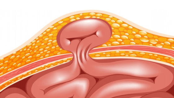 IntellectAdi's tweet photo. Symptoms of Hernia:

>>Swelling in the abdominal wall
>>Heavy feeling in groin or abdomen by constipation or bloody stool
>>Increase in the size of the lump
>>Heartburn and acid reflux

#doctors #medical #healthcare #BIO #content #marketing

Read MOre: https://t.co/EpOETJt3Pz https://t.co/Cg444HHwqL