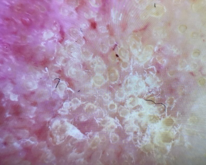 julianconejomir's tweet photo. Lesión de larga evolución en zona de exposición solar. No siempre debe ser un carcinoma basocelular. Piensa también en lupus cronico discoide. La dermatoscopia marca la diferencia.#dermatologia #dermatology https://t.co/sKMHMqED29