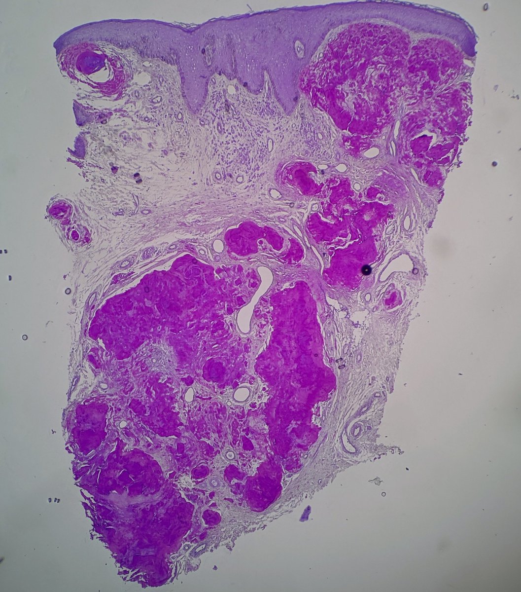 Cutaneous nodular amyloid with h&amp;e and methyl violet.  Sparse plasma cells are usually monotypic.  Need to exclude systemic disease, but most cases are isolated. #dermpath #pathology #dermatology