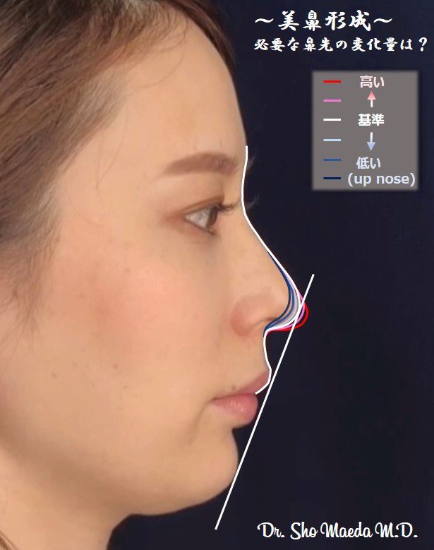 まえしょー 美容外科医 白線がこの方の鼻のラインです 元々の鼻が高いので少し平均的ではありませんが一般的には1 2段階低い方が多いです 一段階くらいの変化は簡単に出すことができますが綺麗な鼻には一定の基準の高さがあり そこを超えないと術後に