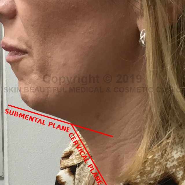 Did you know #jawfiller & #chinfiller only treats the jaw line and you can still have a double chin after having chin filler? #juvederm #jowllift #necklift #jawdefinition #chinaugmentation #exeter #coventry Expert blog by Helen Bowes hmskinbeautiful.blogspot.com/2019/10/why-ch…