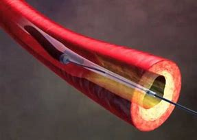 CRMjournal's tweet photo. Article In Press:Turbopower™ laser #Atherectomy with drug-coated #balloon angioplasty  associated with improved oneyear outcomes for the #treatment of #Tosaka Femoropopliteal #instent #restenosis
by @dgkokkinidis@TRFoley4 @StephenWaldoMD @ehrin_armstrong 
https://t.co/vlGx9GtuPy https://t.co/ctu6rFWFU9