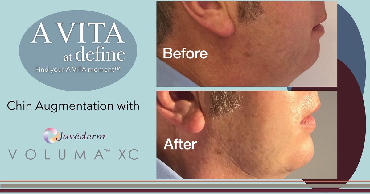 Both Patient and Doctor delighted ! Here at @avitayarm we only use licensed clinical professional Doctors and Nurses to deliver the best quality @juvederm_uk fillers ...Here's VOLUMA ™ used to deliver a chin #augmentation. #Fillers #Expert #Doctor #Yarm #nebloggers