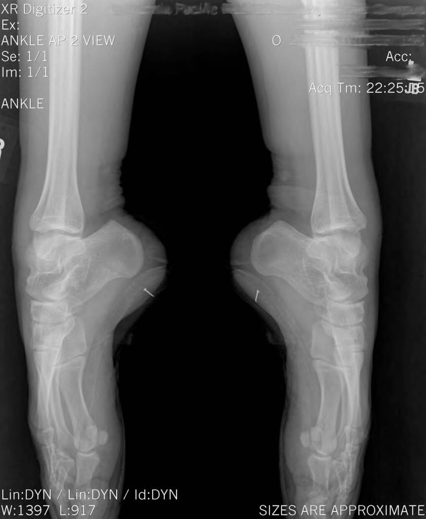 Collection on Twitter "Xray showing a ballet dancer's feet