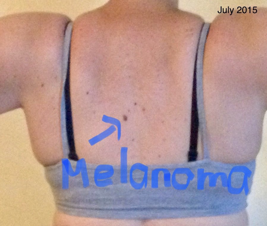 p782203's tweet photo. Randomly looking through old โProgressโ photos, and seeing moles that have maybe changed near your original melanoma puts a serious damper on your day. Wish I had known I would need clear photos back then ๐ฉ. #DoRegularSkinChecks #BeSunSmart #MelanomaAwareness #AlwaysSuspicious https://t.co/MQG1KBGHxS