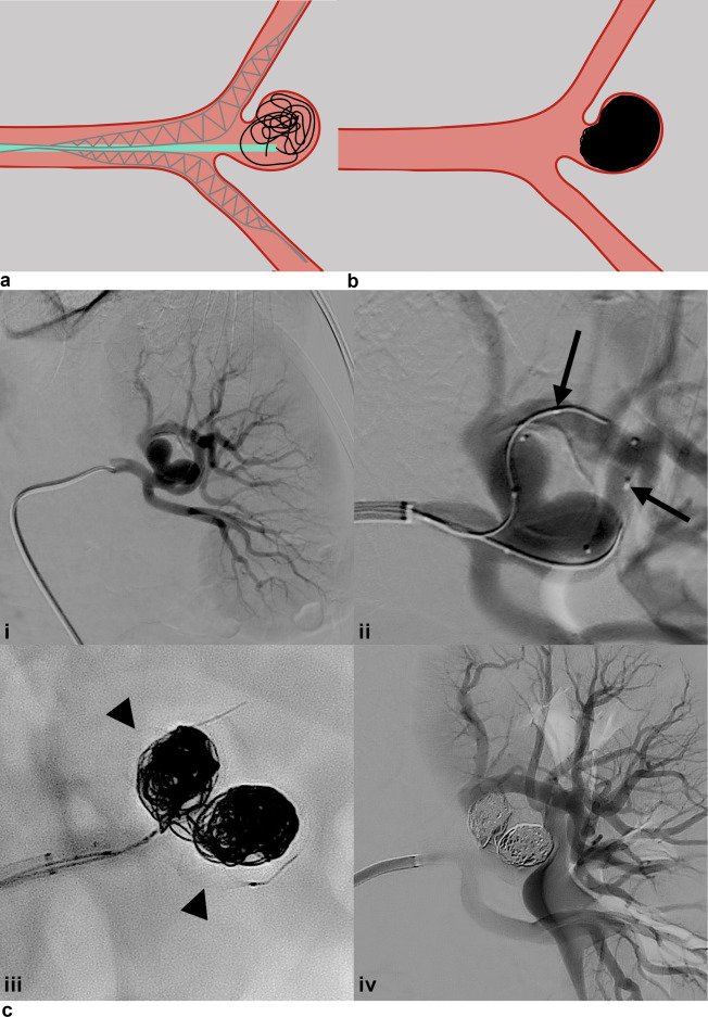 Treatment of Visceral Artery Aneurysms Using Novel Neurointerventional Devices and Techniques | ow.ly/JxRC50vU8dj #irad