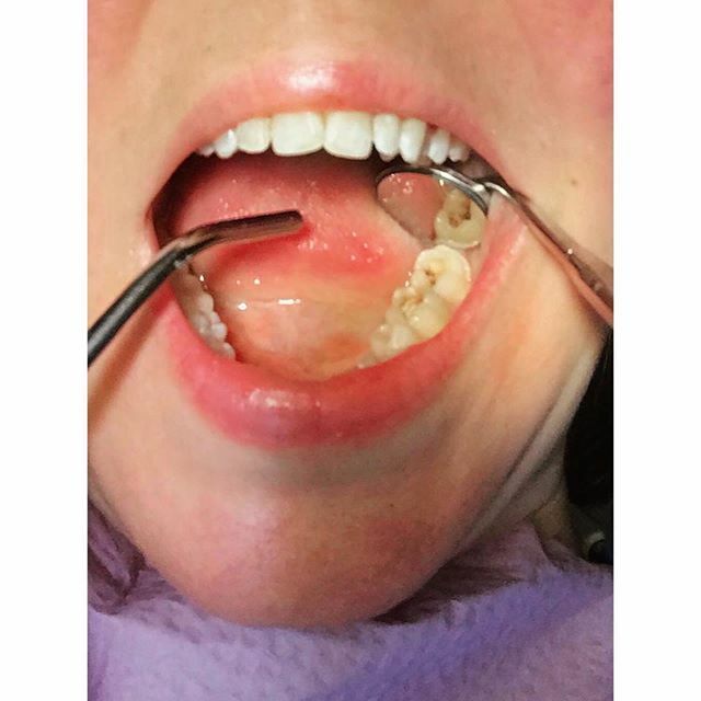 HonestOctober's tweet image. From @rickelle_yeah
・・・
#HonestOctober I have had silver fillings in my back two lower molars since I was young. They have never bothered me, but recently I had started to feel food get stuck in my tooth. (I could always pick it out; it just got supe… ift.tt/2MGqN3P