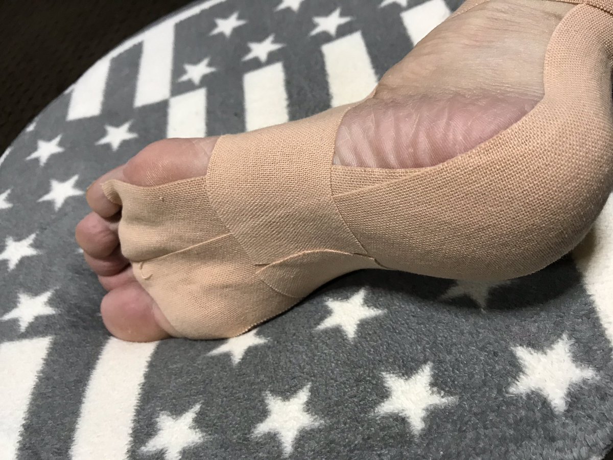白魔女なごみ V Twitter テーピング外して左右を比べると テーピングしていた足は土踏まずが高い していなかった方は扁平足 これが 生活 テーピング の凄いところ 写真撮ってもわかりにくいのが残念 もっと普及して欲しい