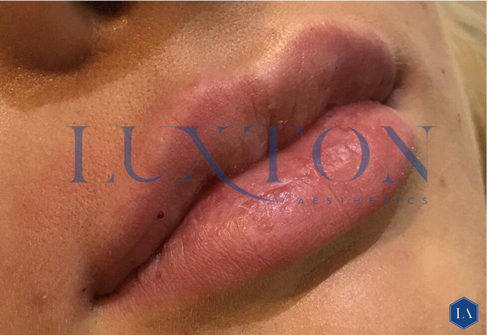 My way with lips - Lips don't have to look "done". A natural, subtle enhancement looks great. #aesthetics #lips #juvedermlips #allergan #lipfillers #fullerlips #london #essex #kent