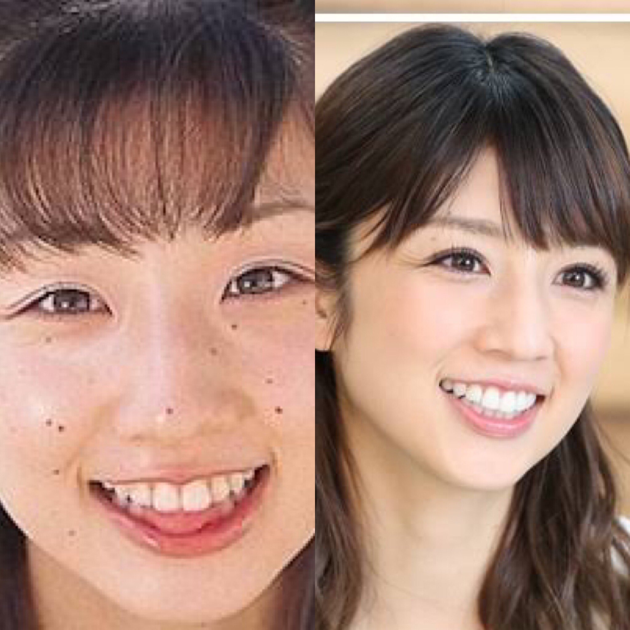 みりん Wi1za7b3gwzblv3 ほくろがたくさんあるなら取った方が良いと思います ほくろがあると 顔を見るときに視界が分散されてなんだかごちゃごちゃしてしまうんですよね 色白さんなら特にです 一通り取ってしまって 真っ白な肌のキャンバスを作って