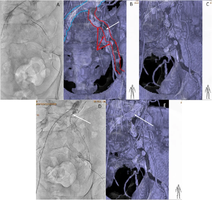 cvirendo's tweet photo. CT fusion 3D roadmap technique for treatment of iliac chronic total occlusion!

https://t.co/hUUY3EONf2 

#IRad #3D #interventionalradiology https://t.co/ExZZgDMykf