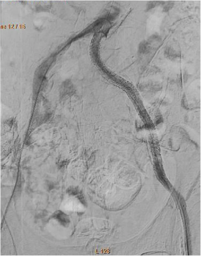 cvirendo's tweet photo. CT fusion 3D roadmap technique for treatment of iliac chronic total occlusion!

https://t.co/hUUY3EONf2 

#IRad #3D #interventionalradiology https://t.co/ExZZgDMykf