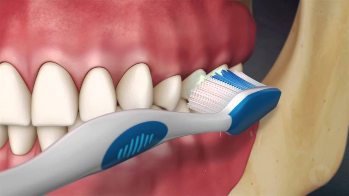 Are you brushing properly? Your toothbrush should be placed at a 45-degree angle to the gums. Then, gently move the brush back and forth in short (tooth-wide) strokes.
#admiredental #dentist #springfieldma #oralhealth #smile