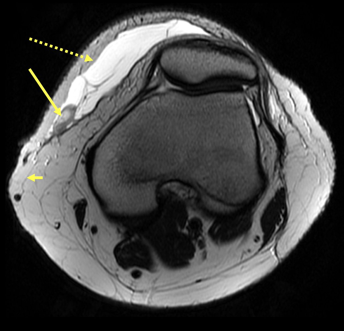 DrPomeranz's tweet photo. Morel-Lavallee lesion (MLL) - https://t.co/Iwr1OpX1CX

The Morel-Lavallee lesion(MLL) results from a closed traumatic degloving soft tissue injury that most commonly occurs in the area of the greater trochanter and knee

#MRI #FOAMRad #RadRes #MSK https://t.co/cmIKrfeKWQ