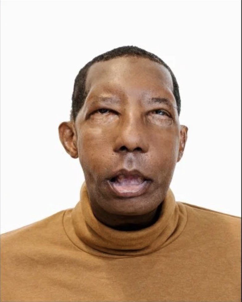 Meet The First African American Face Transplant Recipient 58 Off Meet The First African American Face Transplant Recipient 58 Off
