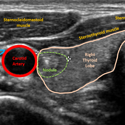 AI boosts ultrasound for thyroid cancer screening. Kate Madden Yee of <a href="/AuntMinnie/">AuntMinnie.com</a> ow.ly/ffDZ50wTdGD
