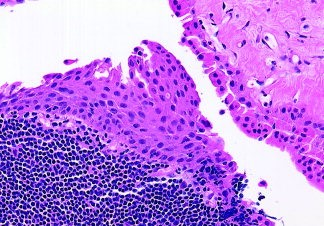 norcaloa's tweet photo. The #lesion can be evaluated with the soft tissue ultrasound to assess the #morphology and the #architectural_aspects.The #diagnosis can be further confirmed by a #fine_needle aspiration cytology or a tru-cut #needle_biopsy.
https://t.co/noz9WeCl1F https://t.co/iUG2hvP6iV