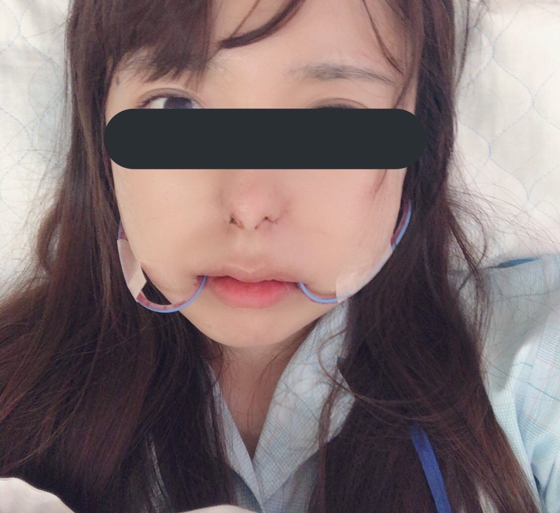 顎変形症 術後 一ヶ月 記録 顎変形症 術後 一ヶ月 記録