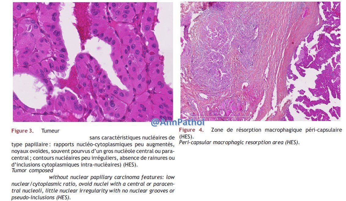 Annpathol's tweet image. 🇫🇷 Femme de 44 ans. Nodule unique du lobe droit de 1,7 cm. Macro : encapsulé et beige.
Diagnostic ?
🇬🇧 44 yo woman. Single nodule of the right lobe of 1.7 cm. Gross: encapsulated and beige.
Diagnosis ?
@Elsevierconnect
#francophonepath, #thyroid, #entpath, #endopath