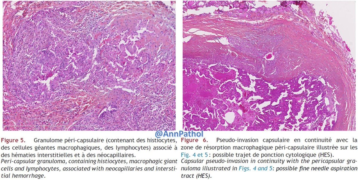 Annpathol's tweet image. 🇫🇷 Femme de 44 ans. Nodule unique du lobe droit de 1,7 cm. Macro : encapsulé et beige.
Diagnostic ?
🇬🇧 44 yo woman. Single nodule of the right lobe of 1.7 cm. Gross: encapsulated and beige.
Diagnosis ?
@Elsevierconnect
#francophonepath, #thyroid, #entpath, #endopath