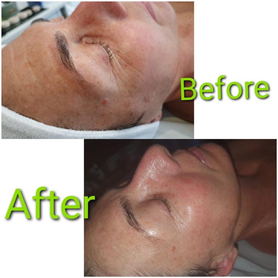 futurethis_SA's tweet photo. Another winner with @teamdrjoseph 🍃 This 80min Supreme Ultra Sonic Facial was done with the Peel and Lift function, and look at those results! An all-natural treatment that works 🤗

#Futurethis https://t.co/QGkKqgWr8l