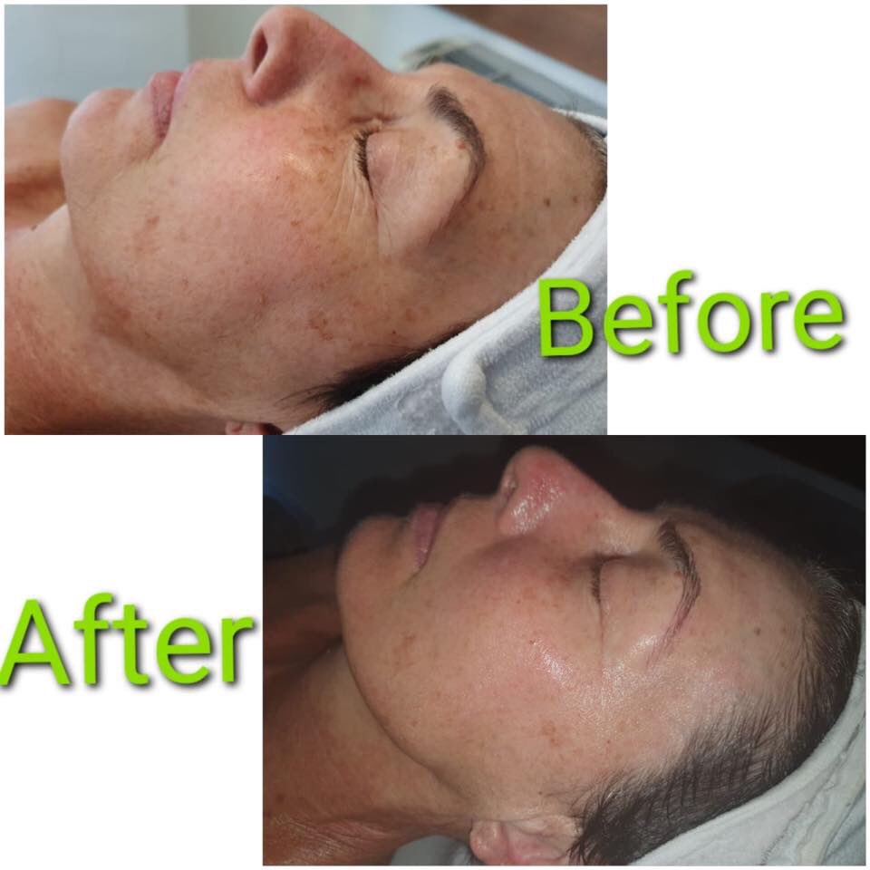 futurethis_SA's tweet photo. Another winner with @teamdrjoseph 🍃 This 80min Supreme Ultra Sonic Facial was done with the Peel and Lift function, and look at those results! An all-natural treatment that works 🤗

#Futurethis https://t.co/QGkKqgWr8l