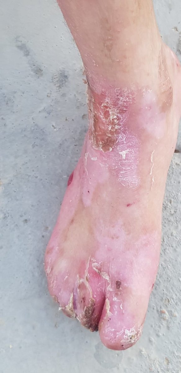 tmoh__2019's tweet photo. حالة انسانية |

" والد الطفلة "جالية جابر أحمد السلمي"، يناشد الجهات العليا والمختصة، علاج طفلته التي تُعاني من مرض انحلال البشرة الفقاعي، الذي بات يهدد حياتها؛ مبينًا أنه فَقَدَ اثنتين من بناته قبلها تُوفّيتا بسبب معاناتهما مع المرض.
@fayez_malki https://t.co/LmATwy9ntj