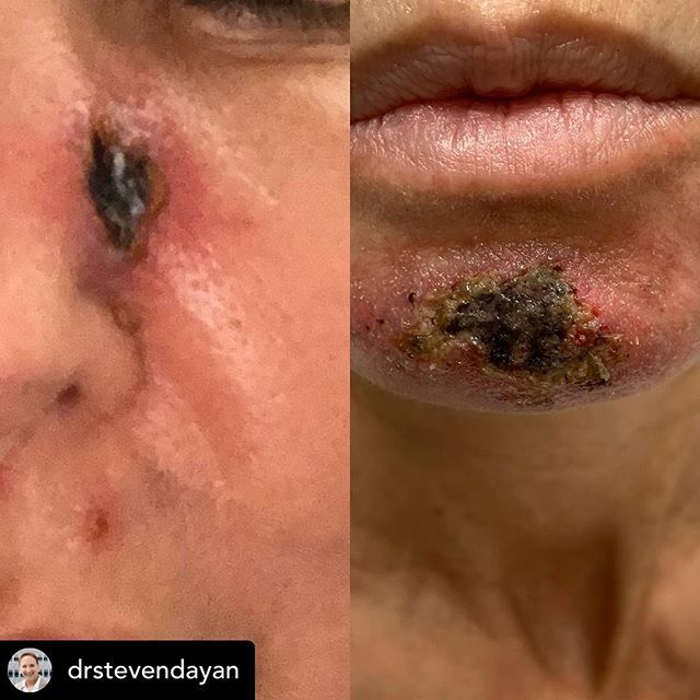 DrEricCarniol's tweet photo. 📣Now this is scary‼️
Thank you @drstevendayan for sharing this. “One of these occurred after micro needling and one after a filler treatment. 
But both happened after being treated at a medspa! 
Please don’t cut corners when it comes to your face. It’s not worth it. An exper… https://t.co/KutcKVYXyv
