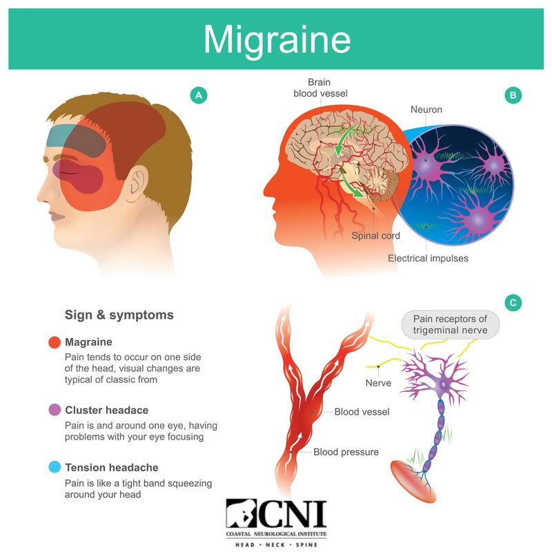 You know how to handle a migraine when you get one, but have you thought about taking preventative measures? Aimovig™ is a new, FDA-approved medication that changes the way migraine sufferers can prevent migraines. #Migraine #Health #CNI #Aimovig